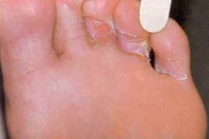 Микробная экзема между пальцами ног