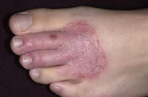 Инфицирование кожи ноги и пальцев
