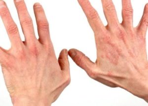 Признаки аллергии на руках
