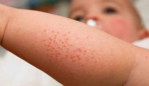 Аллергический недуг у ребенка
