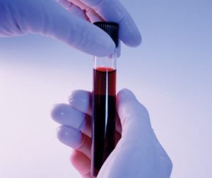 Какие необходим анализы для обнаружения в крови аутоантител