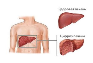 Типы аутоиммунного гепатита 