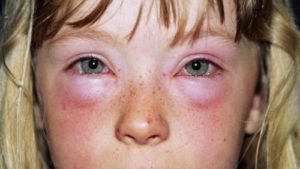 Аллергические симптомы у детей