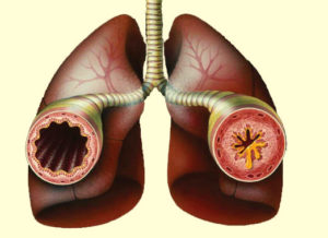 Развитие бронхиальной астмы