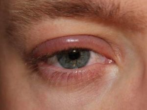 Причины развития глазного
