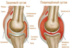 Ревматоидный артрит и поражение суставов