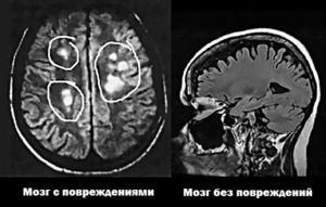 Склероз на МРТ снимках