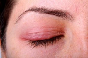 Как распознать глазную аллергию