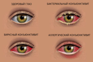 Разные виды вирусного поражения глаз