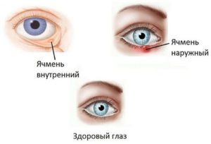 Развитие обоих видов офтальмии (наружного и внутреннего ячменя) 